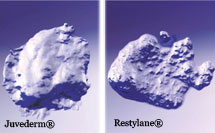 Juvederm vs Restylane